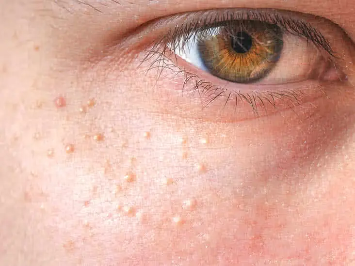 Milia skin condition